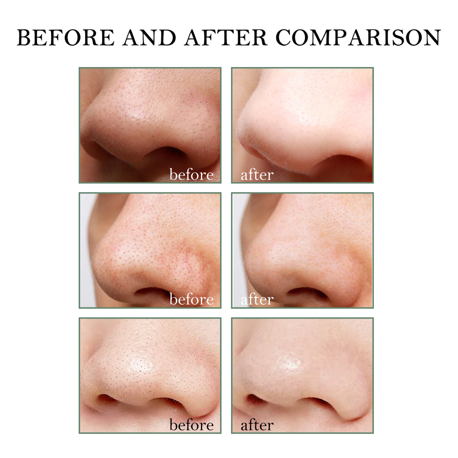 Blackhead Remover Tools -15G Blackhead Creamwith 40Pcs Blackhead Pore Strips