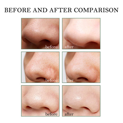 Blackhead Remover Tools -15G Blackhead Creamwith 40Pcs Blackhead Pore Strips